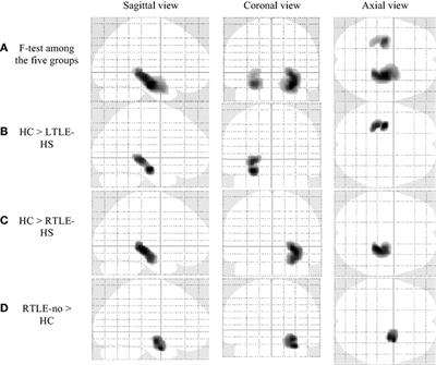 Gray Matter and White Matter Abnormalities in Temporal Lobe Epilepsy Patients with and without Hippocampal Sclerosis